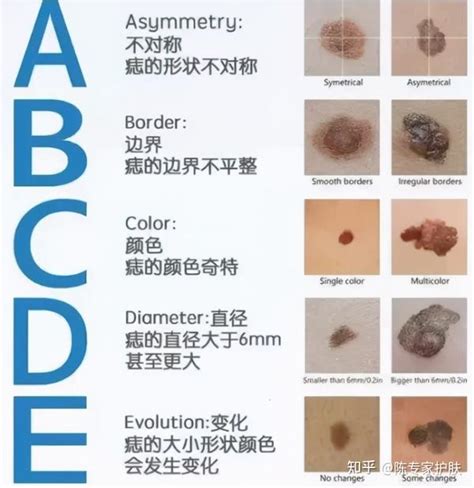 痣的顏色|皮膚科 痣